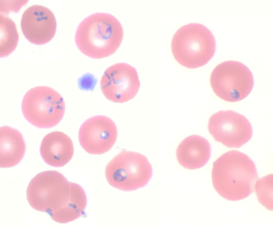 Кръвна натривка с Babesia microti в червените кръвни клетки под микроскоп